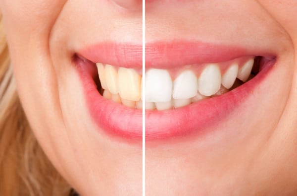 Why professional teeth whitening is the best choice?