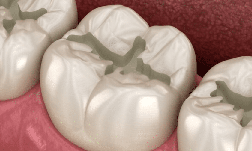 How To Know If You Have A Crack In Your Dental Filling?