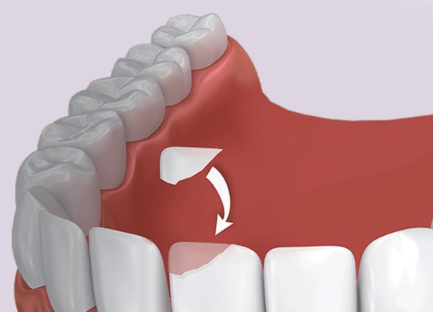 Dental diagram showing gum recession with arrow indicating tissue loss on tooth root.