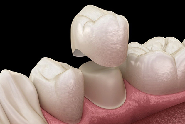 Dental crowns being placed on teeth model showing restorative dentistry procedure