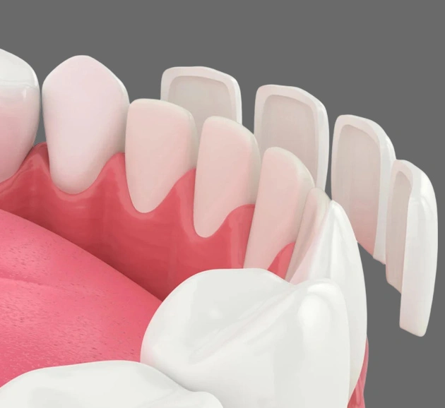Dental veneers displayed on pink gum model showing tooth whitening and cosmetic dentistry restoration.