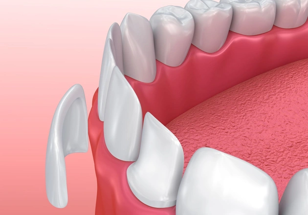 3D dental illustration showing veneer placement on front teeth against pink gum background.