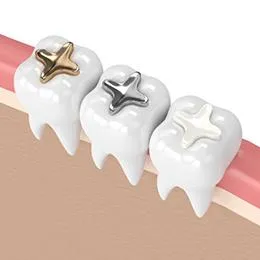 Three white tooth models with different crown options displayed on pink gum base.