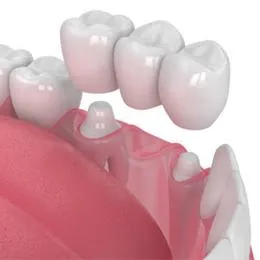 Dental implant model showing tooth restoration on pink gum structure with prosthetic teeth.