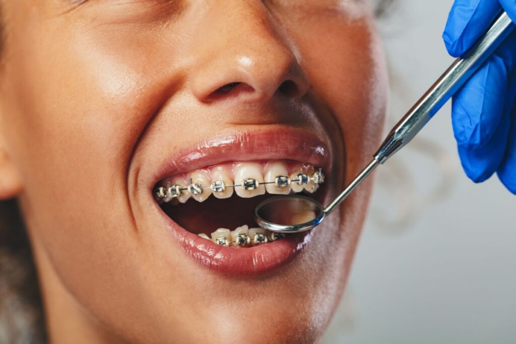 Close-up of a patient wearing traditional metal braces during an orthodontic checkup, highlighting a common teeth-straightening treatment option.